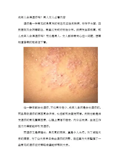 成年人会得湿疹吗？男人女人必看内容