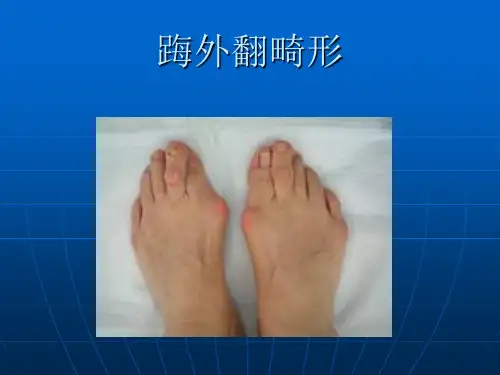 踇外翻