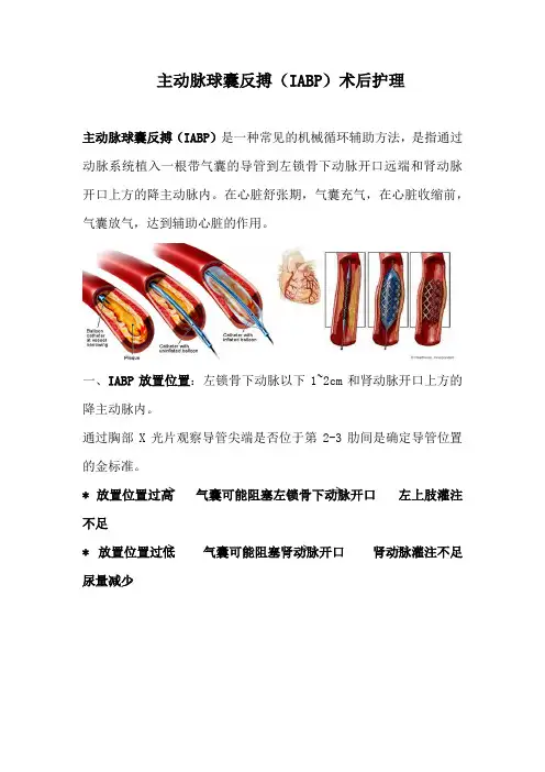 主动脉球囊反搏(IABP)术后护理