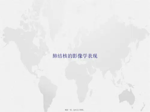 肺结核的影像学表现2讲课文档