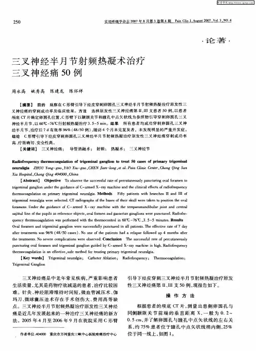 三叉神经半月节射频热凝术治疗三叉神经痛50例