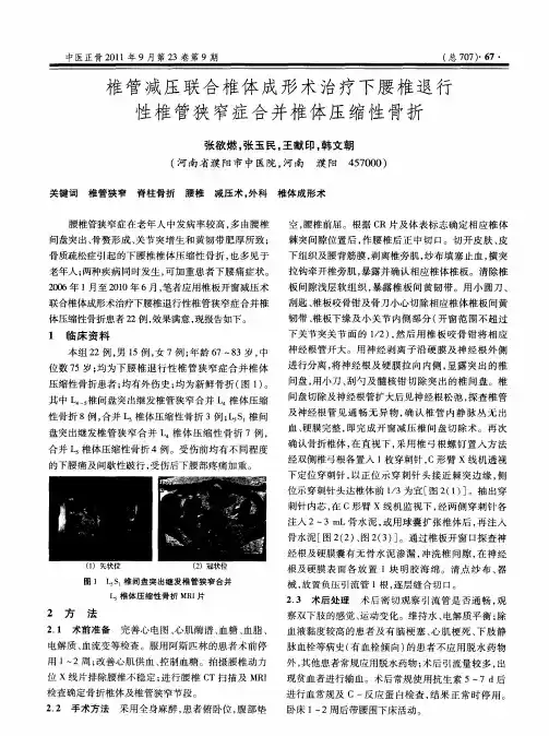椎管减压联合椎体成形术治疗下腰椎退行性椎管狭窄症合并椎体压缩性骨折