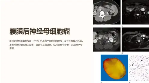 腹膜后神经母细胞瘤修改版课件