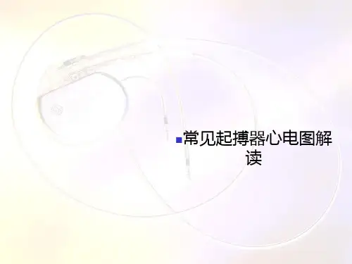 常见起搏器心电图解读