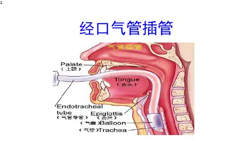 气管插管操作讲解