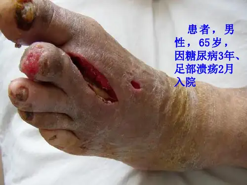 糖尿病足进展图片PPT.