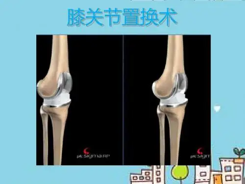 膝关节置换
