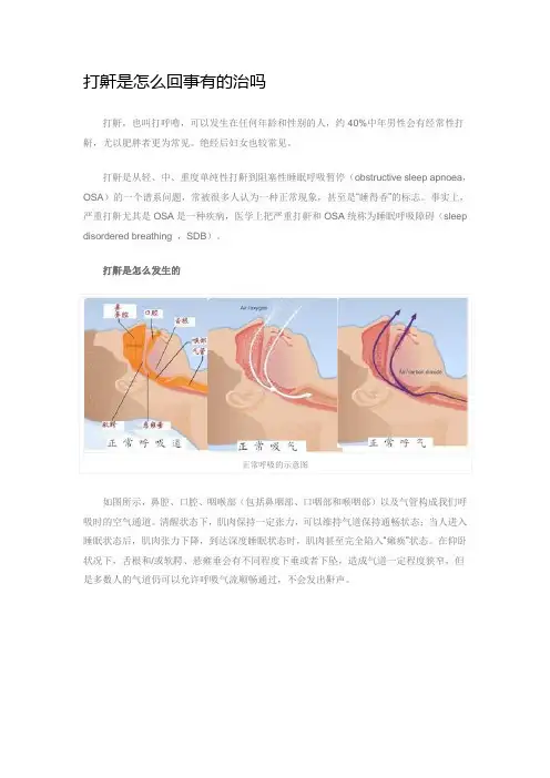 打鼾是怎么回事有的治吗