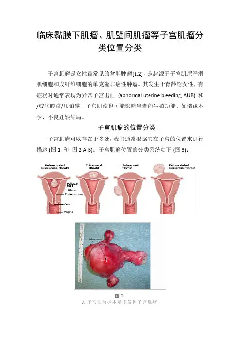 临床黏膜下肌瘤、肌壁间肌瘤等子宫肌瘤分类位置分类
