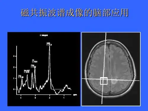 磁共振波谱成像的脑部应用