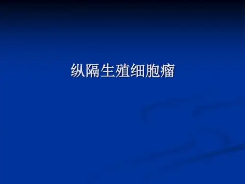 纵隔生殖细胞瘤