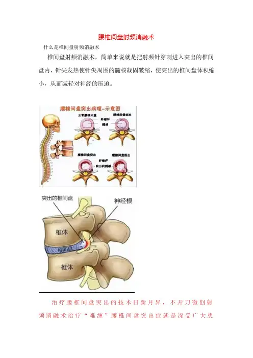 腰椎间盘射频