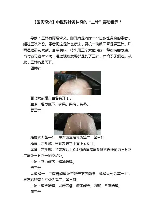【董氏奇穴】中医界针灸神奇的“三针”轰动世界！