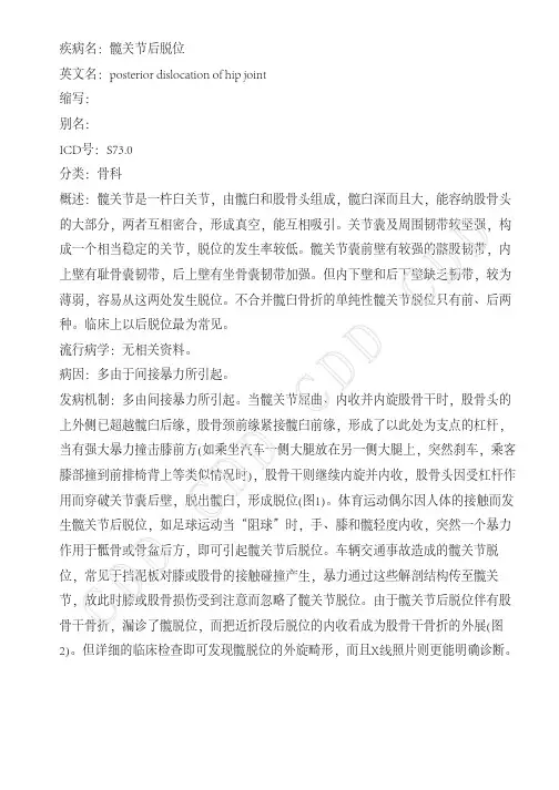 髋关节后脱位