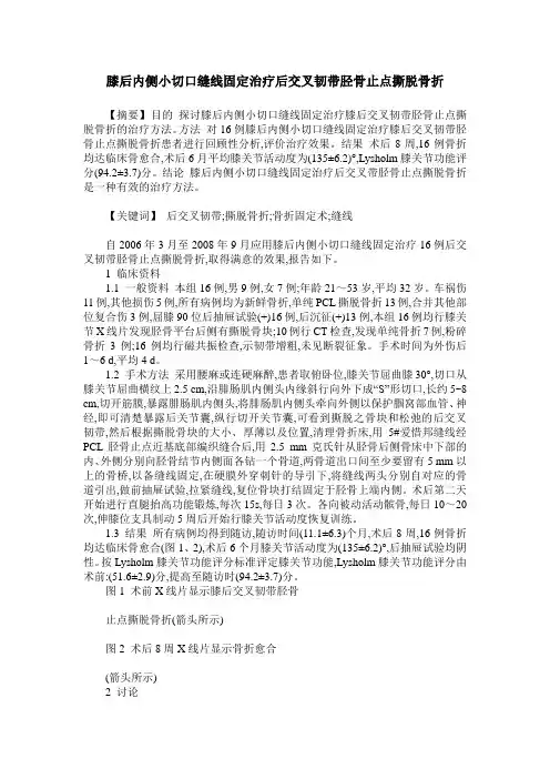 膝后内侧小切口缝线固定治疗后交叉韧带胫骨止点撕脱骨折