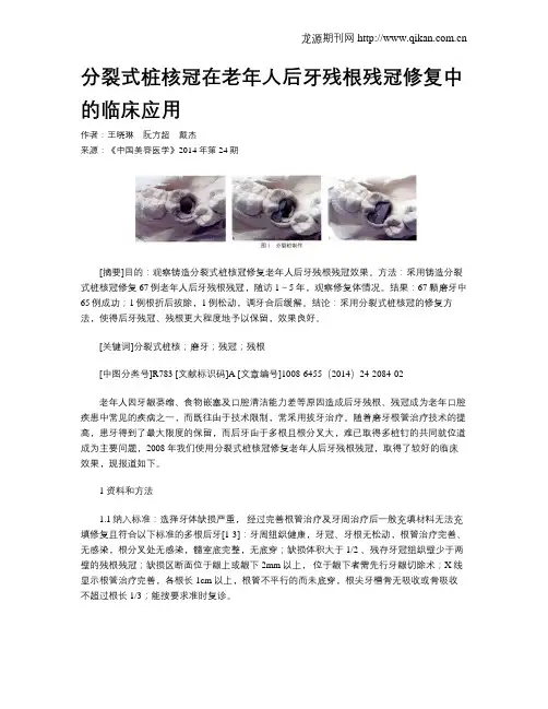分裂式桩核冠在老年人后牙残根残冠修复中的临床应用