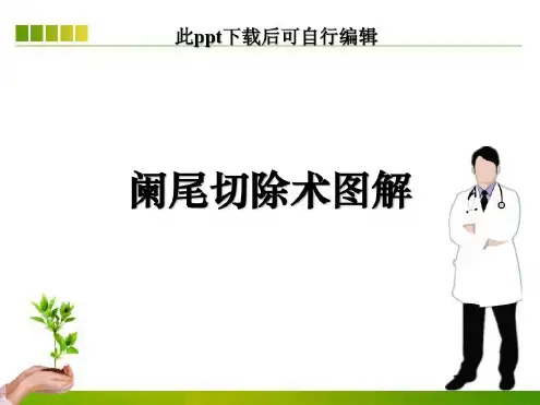 阑尾切除术图解-2022年学习资料