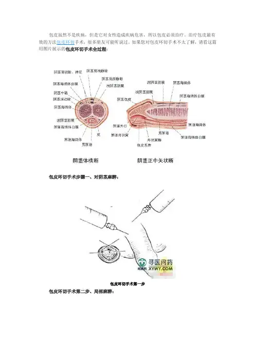 包皮环切术