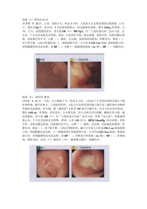 消化性溃疡典型病案