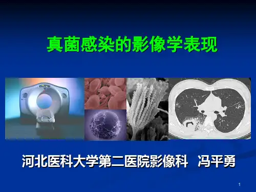 真菌感染的影像学表现ppt课件