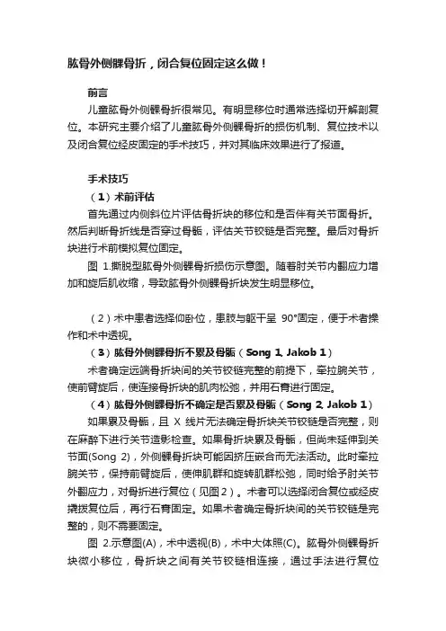 肱骨外侧髁骨折，闭合复位固定这么做！