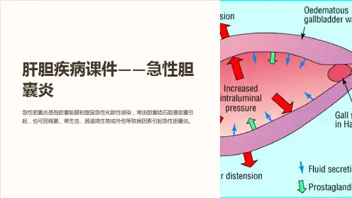 《肝胆疾病课件-急性胆囊炎》