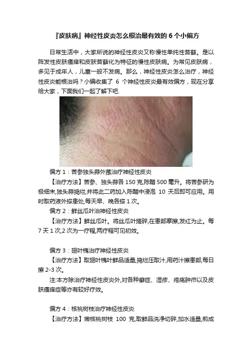『皮肤病』神经性皮炎怎么根治最有效的6个小偏方