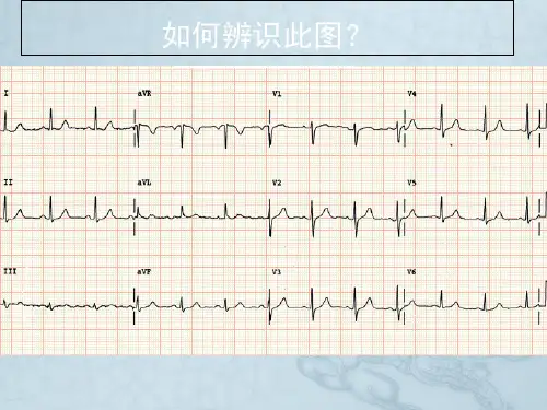 杏树林讲座正确识别心电图