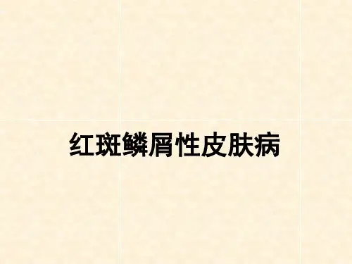 寻常型银屑病