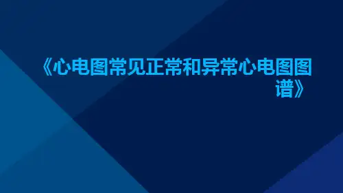 心电图常见正常和异常心电图图谱