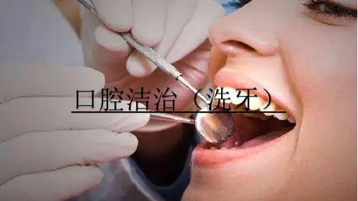 口腔洁治