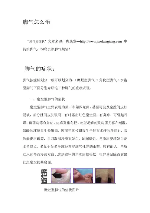 脚气怎么治