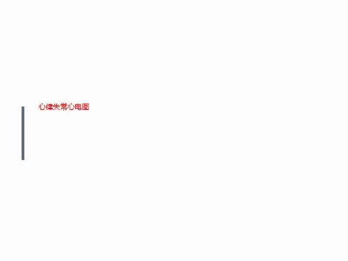 心律失常心电图
