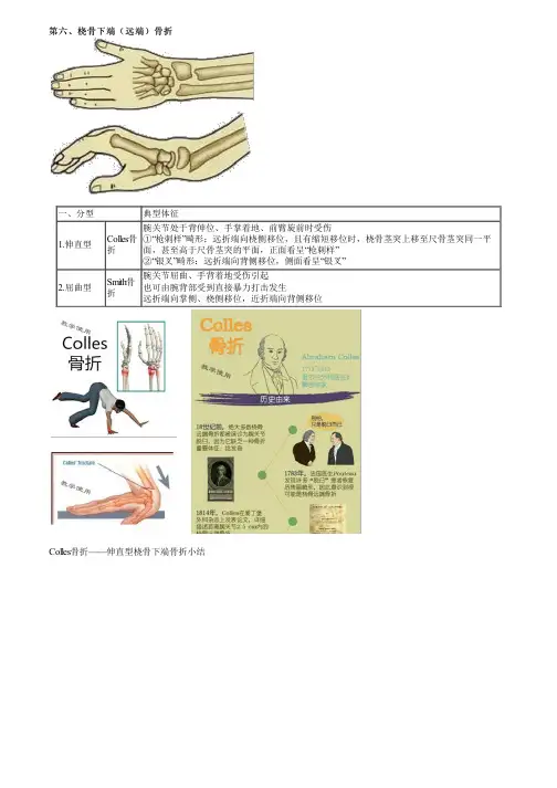 西医职业医师桡骨下端(远侧)骨折(一)