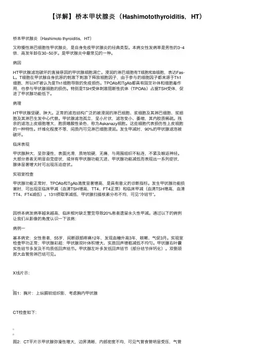 【详解】桥本甲状腺炎（Hashimotothyroiditis，HT）
