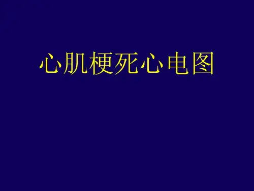 心肌梗塞