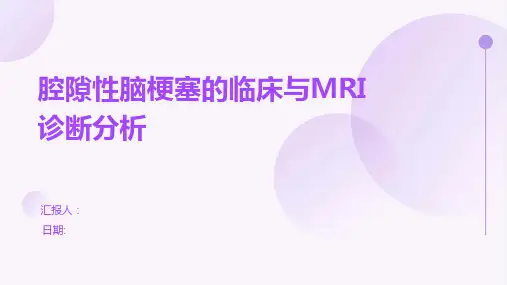 腔隙性脑梗塞的临床与MRI诊断分析