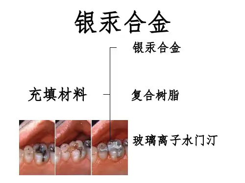 银汞合金
