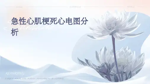 急性心肌梗死心电图分析