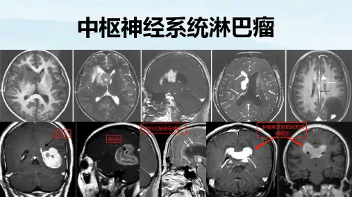 中枢神经系统淋巴瘤 概述及影像学特点、诊治流程(最新)