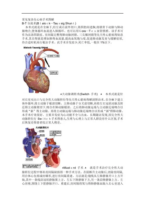 常见复杂先心病手术图解