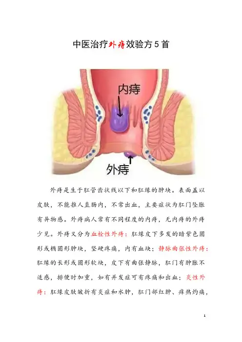 中医治疗外痔效验方5首