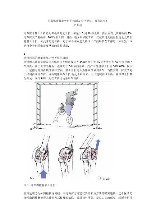 儿童肱骨髁上骨折的诊断及治疗要点