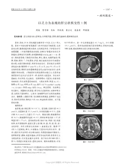 以乏力为表现的肝豆状核变性1例