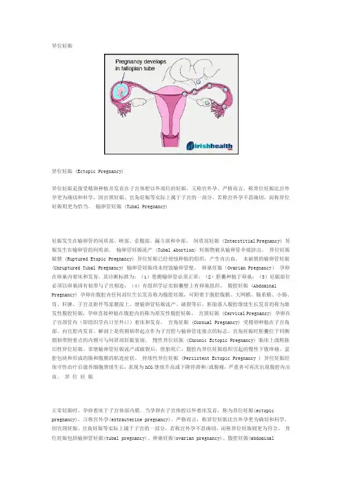 异位妊娠