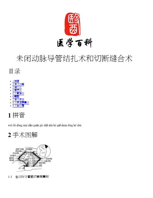 百科知识：未闭动脉导管结扎术和切断缝合术