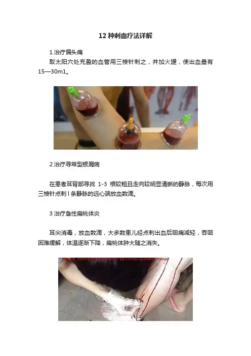 12种刺血疗法详解