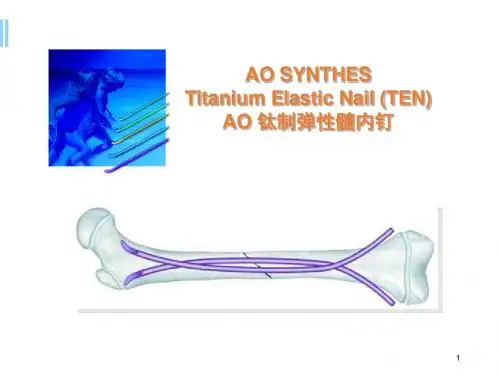 (医学课件)弹性髓内钉PPT幻灯片