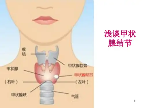甲状腺结节浅谈PPT课件