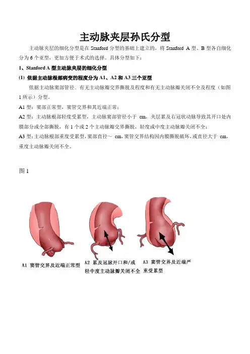 夹层分型及治疗方式